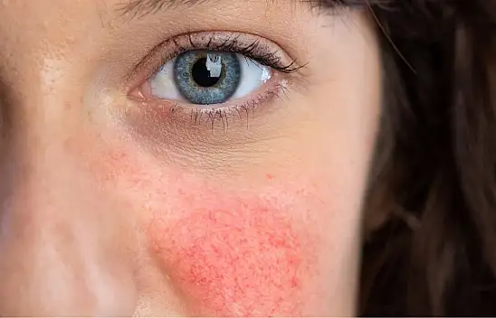 Rosa Hastalığına Doğal Çözüm Tavsiyeleri